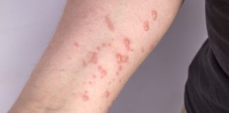 A Secretaria Municipal de Saúde de Nova Venécia através da Vigilância Epidemiológica confirma o primeiro caso de Monkeypox no município